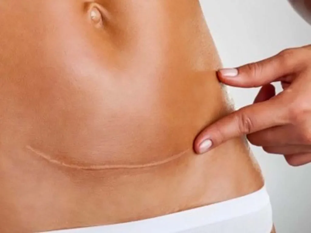 C-Section Scar